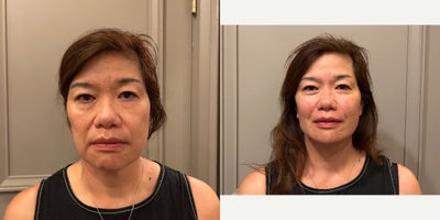before and after image