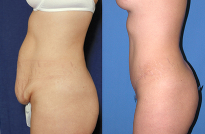 Tummy Tuck before and after photo