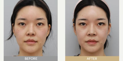 Cheekbone Reduction before and after photo
