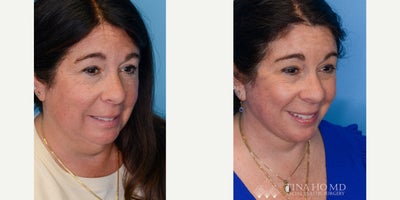 Neck Lift before and after photo
