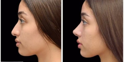 Rhinoplasty before and after photo