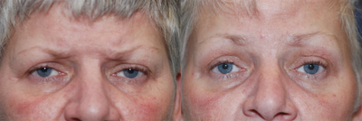 Brow Lift before and after photo