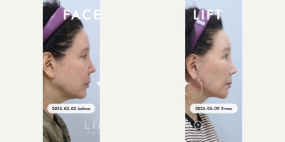 Buccal Fat Removal before and after photo