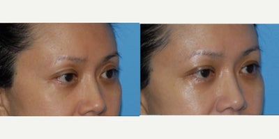 Facial Fat Transfer before and after photo