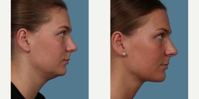 PrecisionTx before and after photo