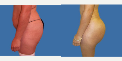 Brazilian Butt Lift before and after photo