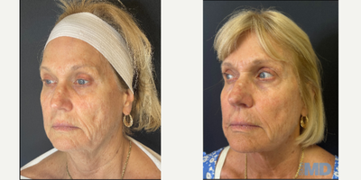 FaceTite before and after photo