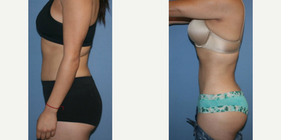 Liposuction before and after photo