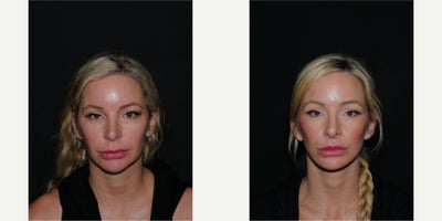 Neck Lift before and after photo