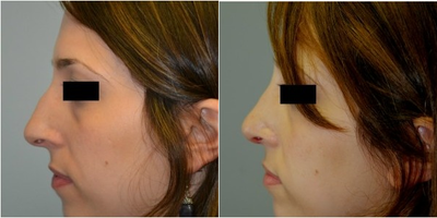 Rhinoplasty before and after photo