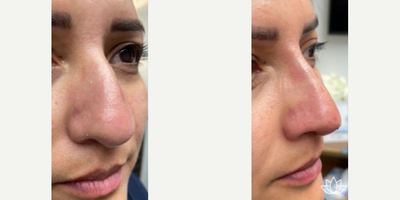 Thread Lift before and after photo
