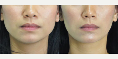 Botox before and after photo