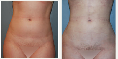 Brazilian Butt Lift before and after photo