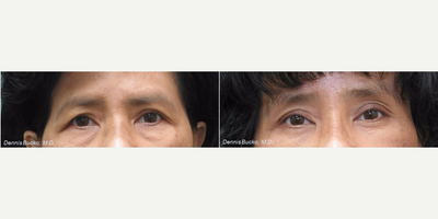 Brow Lift before and after photo