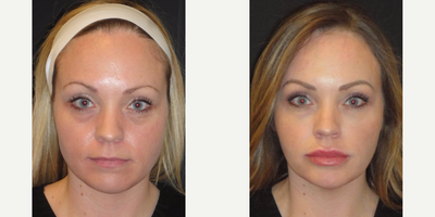 Lip Fillers before and after photo