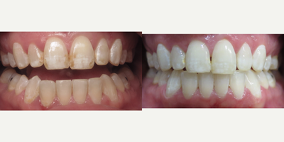 Teeth Whitening before and after photo