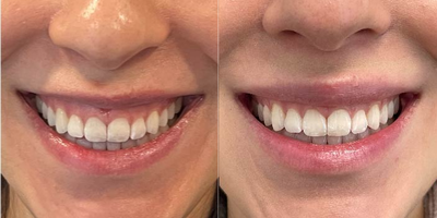 Botox before and after photo