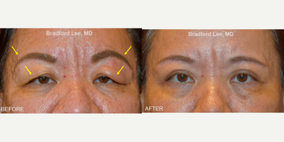 Double Eyelid Surgery before and after photo