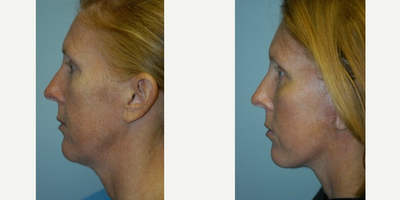 Facelift before and after photo