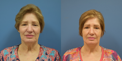 Facelift before and after photo