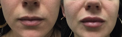 Lip Fillers before and after photo