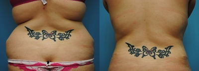 Liposuction before and after photo