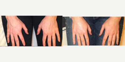 Radiesse before and after photo