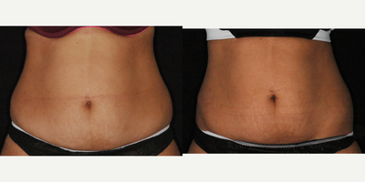 SculpSure before and after photo