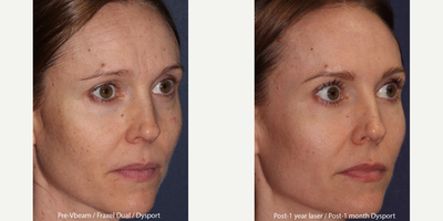 Vbeam before and after photo