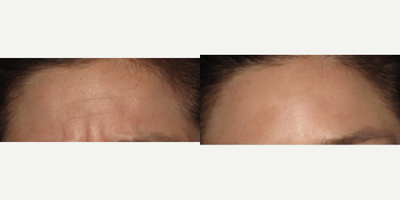 Botox before and after photo