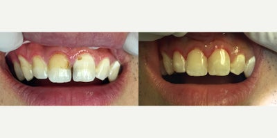 Dental Bonding before and after photo