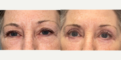Eyelid Surgery before and after photo