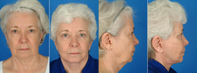 Facelift before and after photo