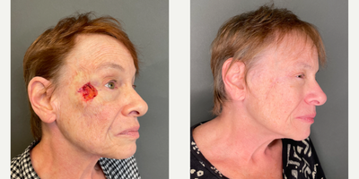 Mohs Surgery before and after photo