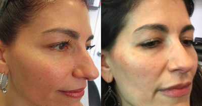 Restylane Silk before and after photo