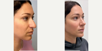 Rhinoplasty before and after photo