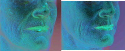 Fractional Laser before and after photo