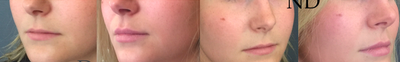 Lip Fillers before and after photo