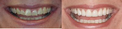 Porcelain Veneers before and after photo