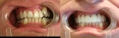 Smile Makeover before and after photo