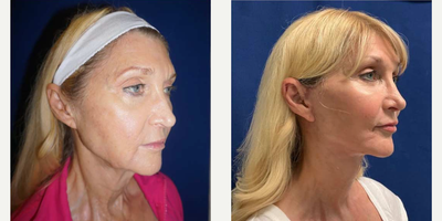 Facelift before and after photo