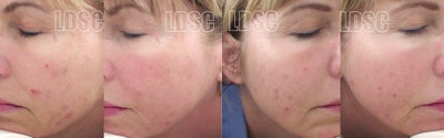 Fraxel Laser before and after photo