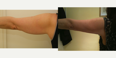 Vaser Liposuction before and after photo