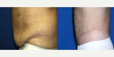 Body Lift before and after photo