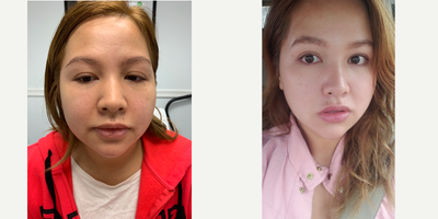 Botox before and after photo