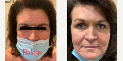 Mini Facelift before and after photo