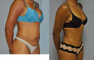 Tummy Tuck before and after photo