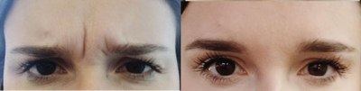 Botox before and after photo