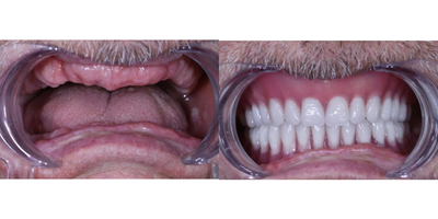Dental Crown before and after photo