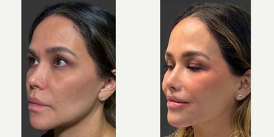 Facelift before and after photo